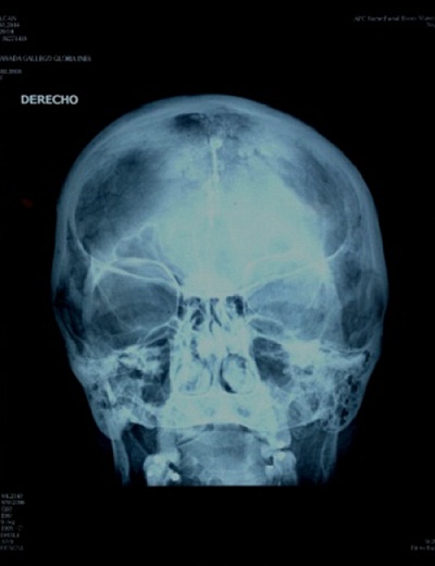 Radiografía
simple de cráneo*