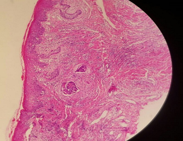 Corte
histológico de la lesión localizada en el labio superior del lado derecho (coloración
hematoxilina-eosina)*