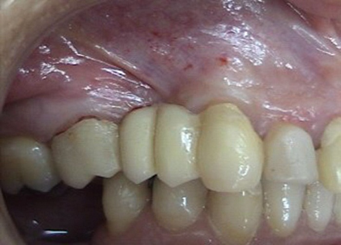 Atrofia alveolar tipo I
moderada en los dientes 14 y 15 (clasificación dígito dos)