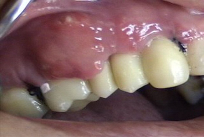 Formación
de absceso posoperatorio