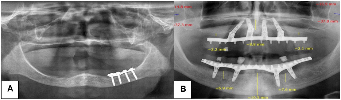 Hallazgos radiográficos en los maxilares de pacientes
con edentulismo total