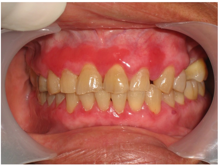 Liquen atípico atrófico en el maxilar superior, color rojo localizado
en la encía marginal y adherida