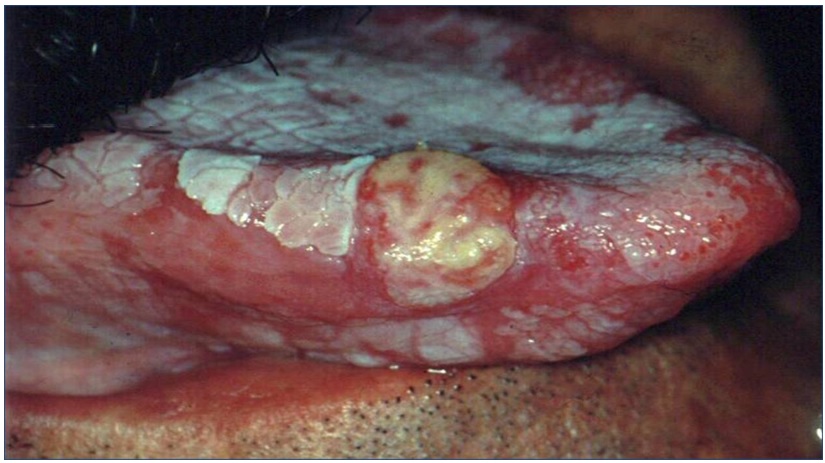 Eritroleucoplasia con zonas rojas y blancas
en la cara dorsal, ventral de lengua