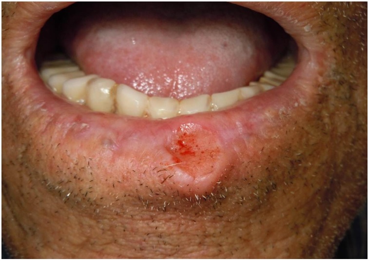 Úlcera en
semimucosa labial inferior y borde bermellón en paciente
con queilitis actínica