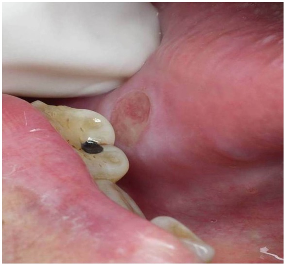 Úlcera traumática crónica en el borde lateral
derecho de la lengua (obsérvese la relación con el diente posterior inferior derecho)