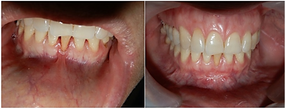 Caso 2. Aspecto periodontal (imagen izquierda)
con sobreinserción del frenillo antes y 15 días después
del procedimiento (imagen derecha)