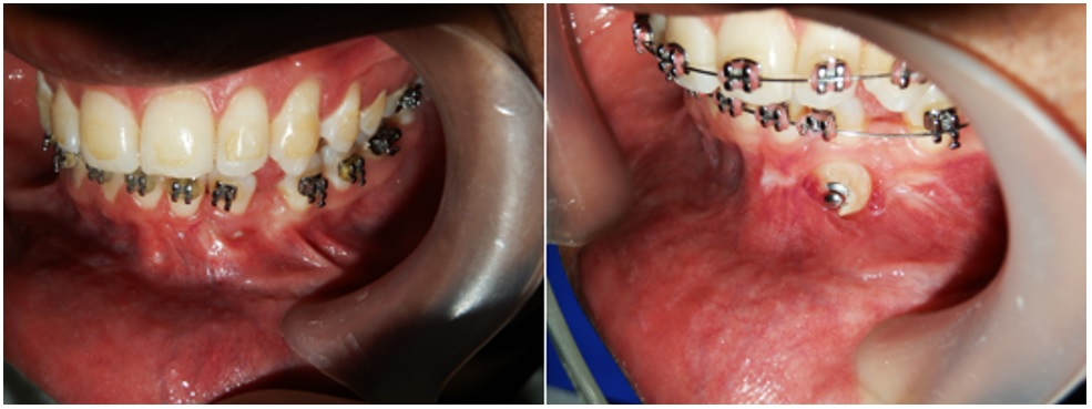 Caso 3. Aspecto clínico (imagen izquierda) con
ausencia del diente 33 antes y 15 días después del procedimiento y con el botón
ortodóntico (imagen derecha)