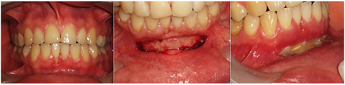 Caso 4. Aspecto clínico con recesión marcada en
la zona anterior del diente 41 (imagen izquierda) antes, inmediatamente después
de haber hecho la incisión en el fondo del surco (imagen central) y ocho días después
del procedimiento, donde se observa la formación de tejido granular (imagen derecha)