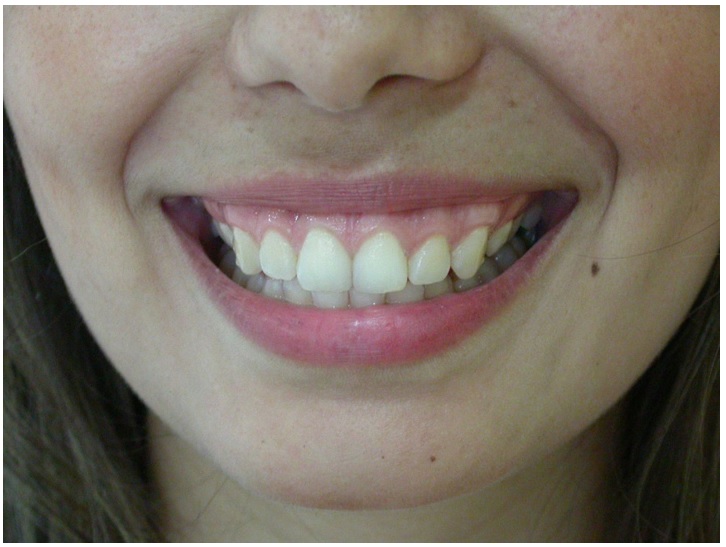 Persistence of gummy smile after gingivoplasty (30 days)