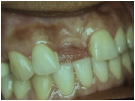 Atrofia alveolar grado I moderada en el área del diente 11